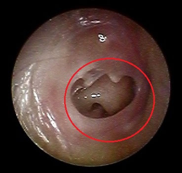 鼓膜に大穿孔が見られ、耳小骨が露出しています。