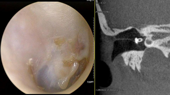 ＊真珠腫を摘出し人工骨を用いて耳小骨を再建したものです